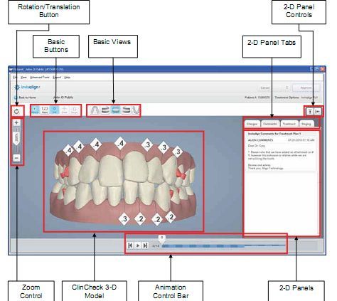 ClinCheck treatment plan example for Invisalign Full